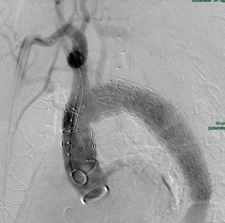 Die intraoperative Abschlussangiografie zeigt die erfolgreiche Implantation der...
