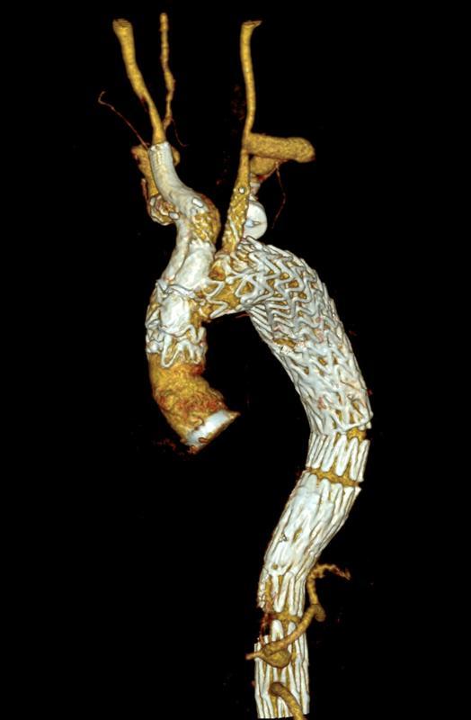 Computertomographie-Angiographie-Kontrolle der komplexen endovaskulären...