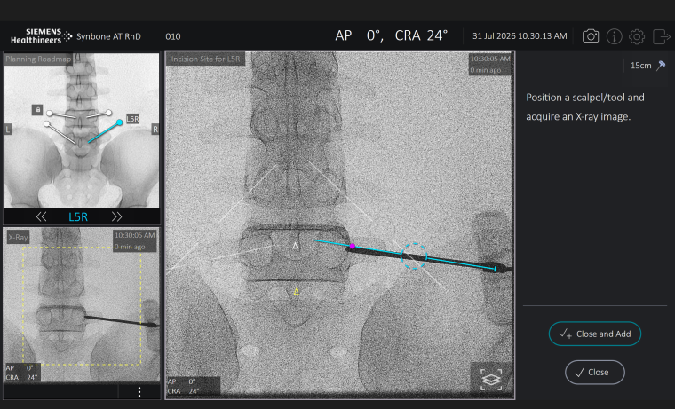 Die Tracking-Software Vuze von Siemens Healthineers unterstützt die...